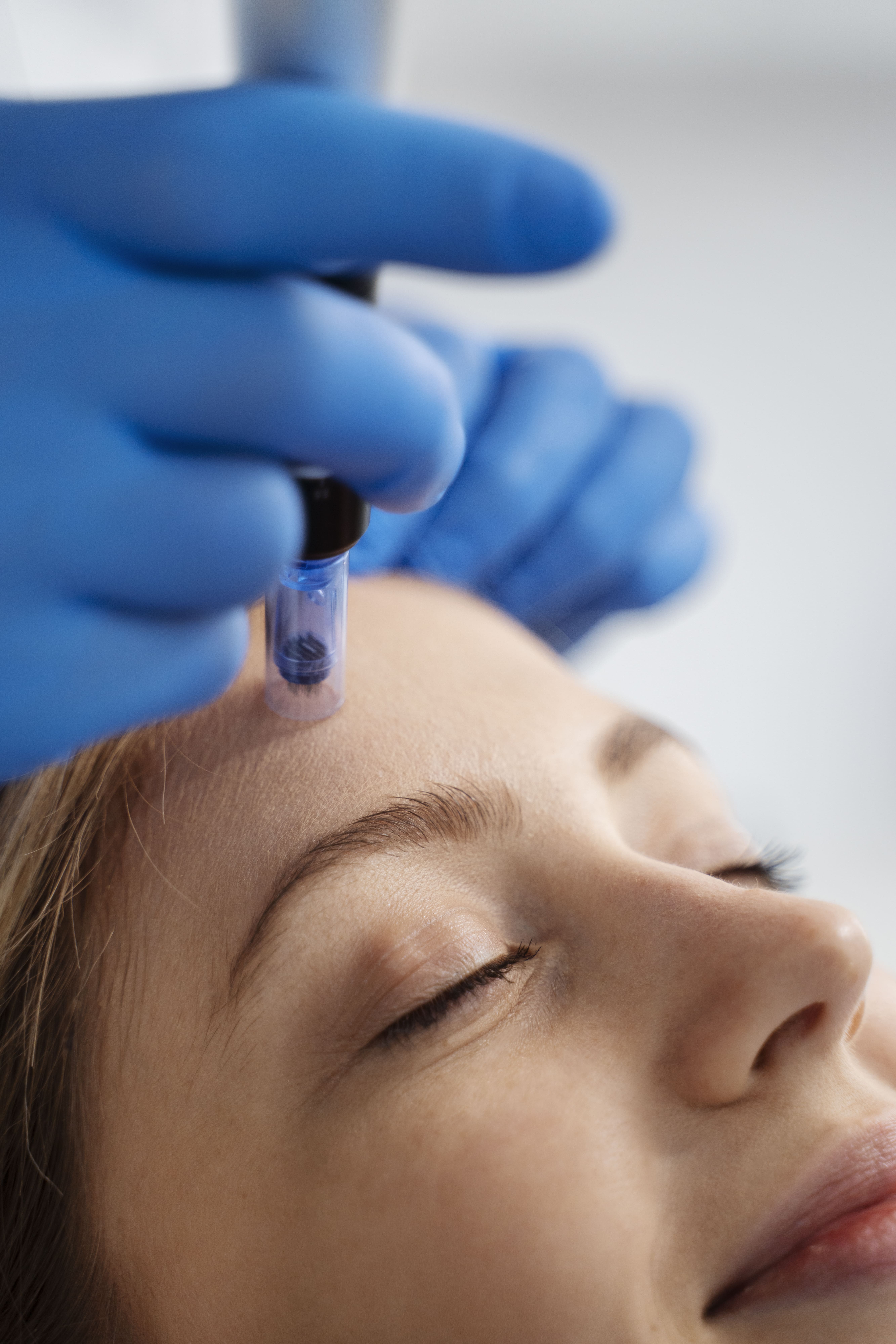 Microneedling_Dermabrasion_Kaltpeeling_Mesotherapie